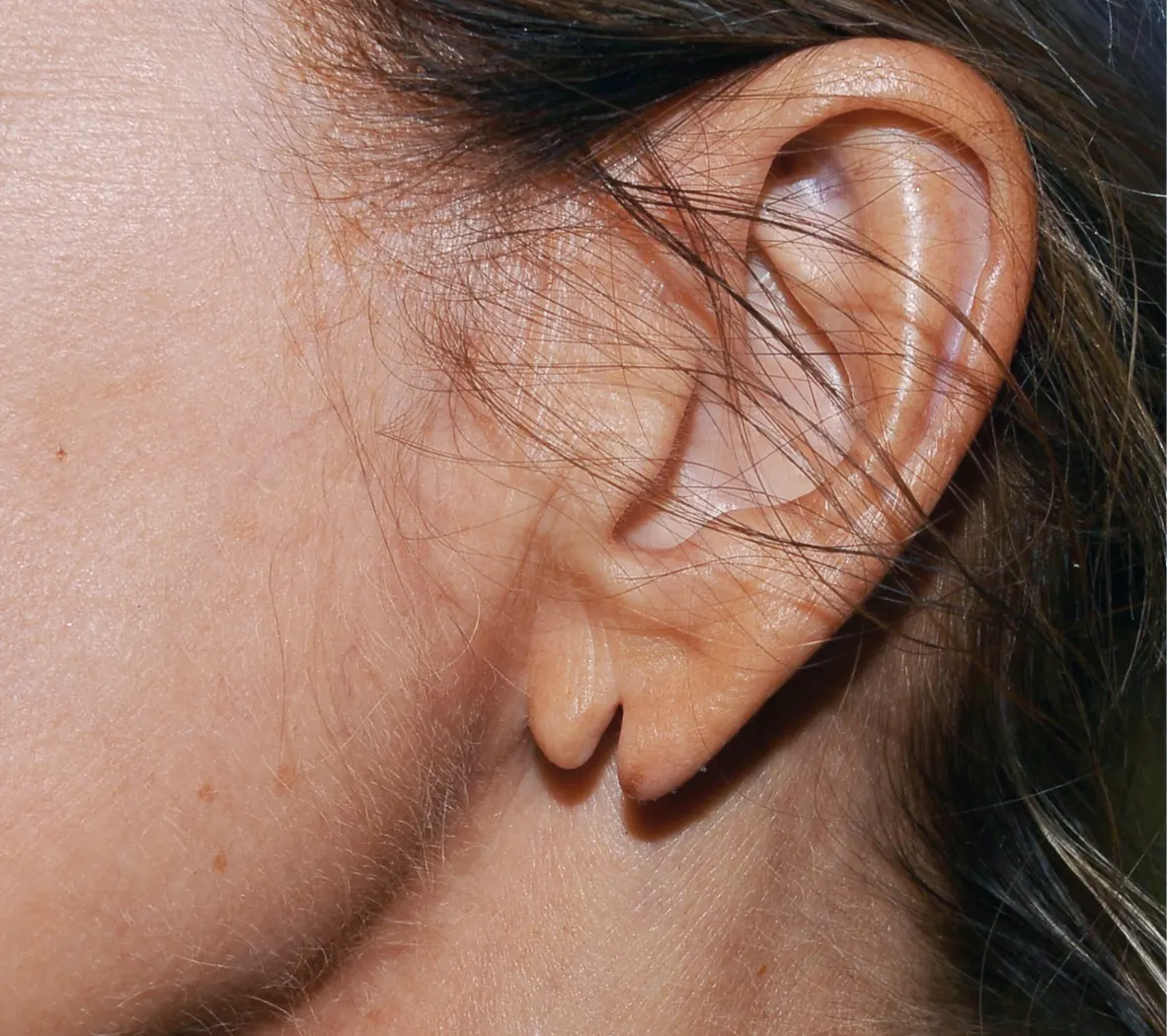 Split Earlobe
